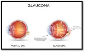 glaucoma treatment, eye doctor, optometrist